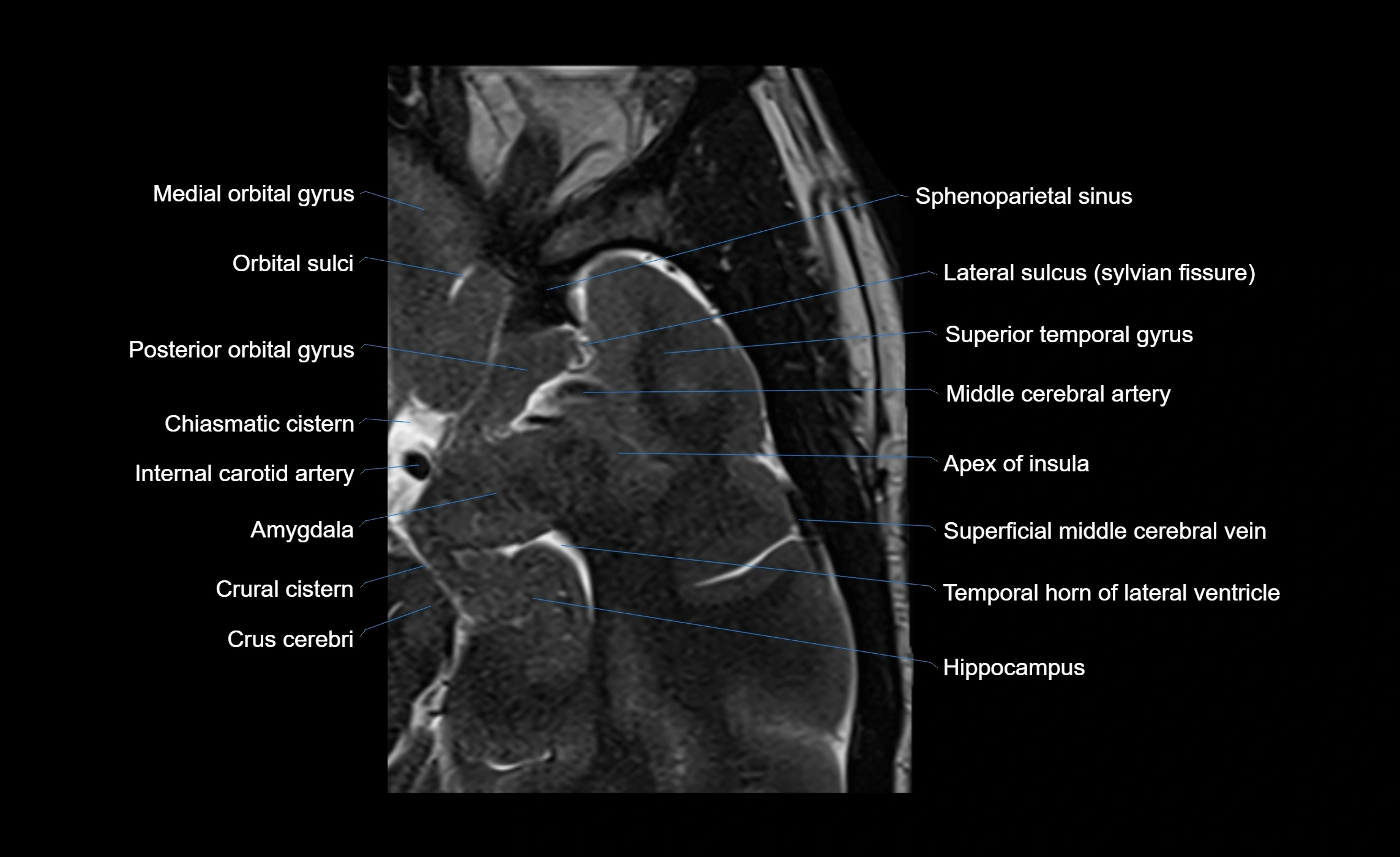 Brain insula axial  anatomy 3T MRI image-img-00001-00001.webp
